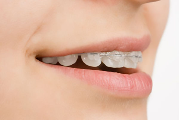 Are There Clear Braces Options?
