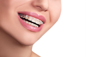 Dental Metal Ceramic Lingual Braces, Invisalign Clear Aligners