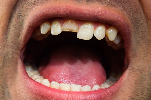 Treatment Options For A Chipped Tooth By A Cosmetic Dentist