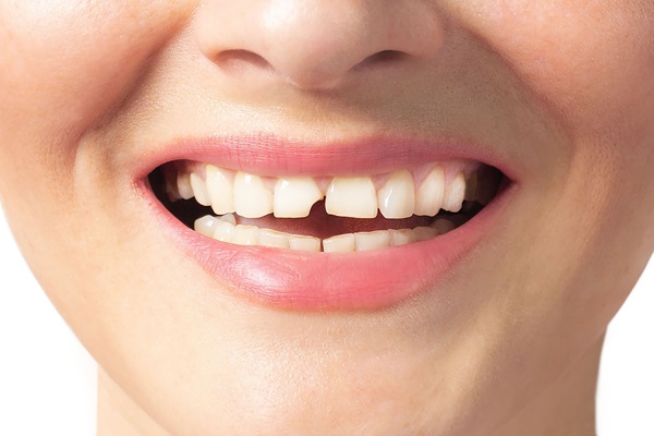 Chipped Tooth Repair Options: Bonding, Veneers, And More