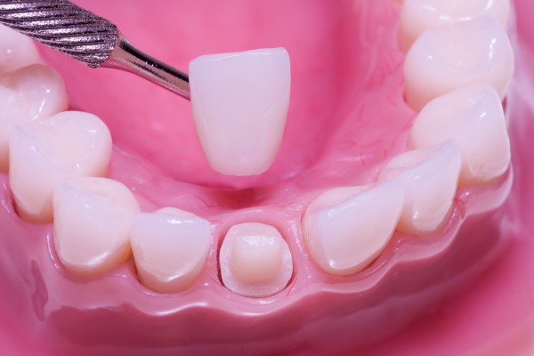 Dental Crowns As A Cosmetic Treatment