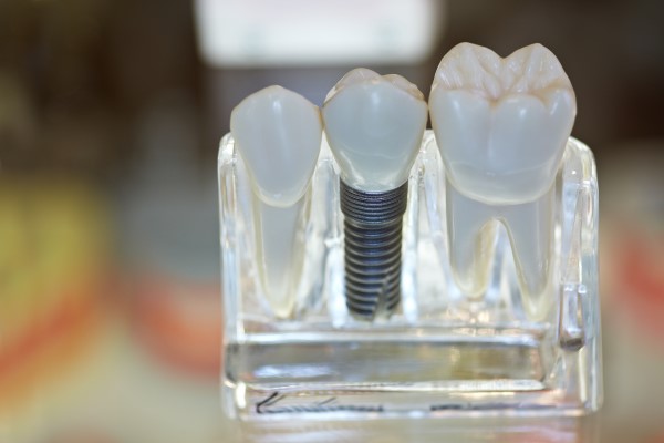 Dental Implant Surgery Bakersfield, CA