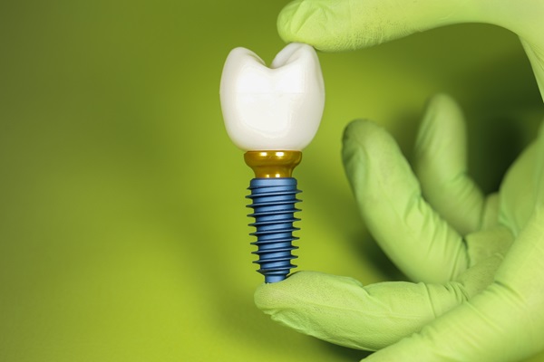 A Guide To Partial And Full Arch Dental Implants