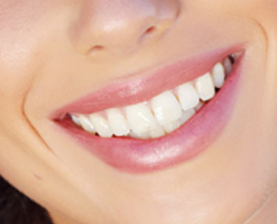What Is Gum Contouring for Dental Veneers? - Brimhall Dental Group  Bakersfield California