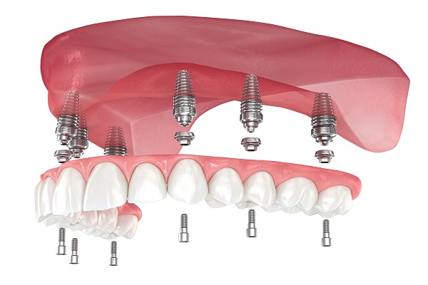 Implant Overdentures From An Implant Dentist