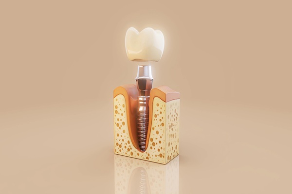 The Importance Of Implant Restoration