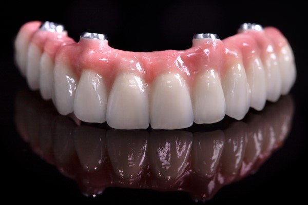 What Full Mouth Dental Implants Are