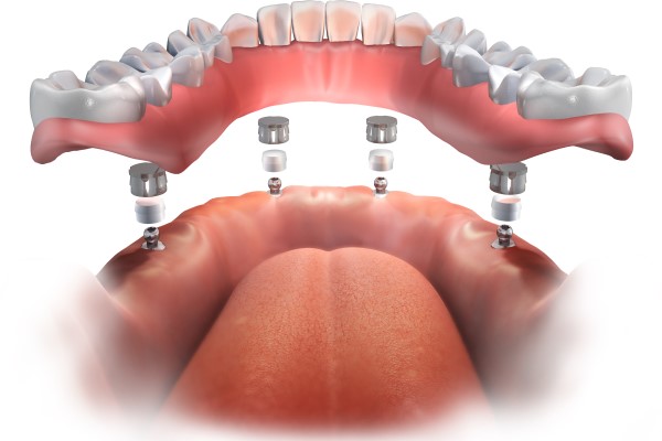 Implant Supported Dentures: Secure, Comfortable, And Natural Looking Smiles