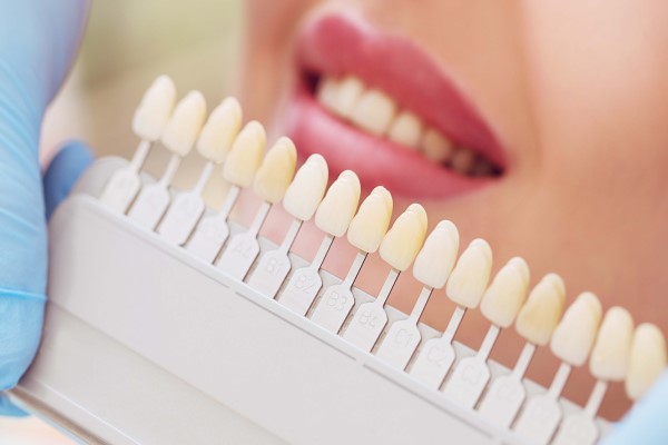 Everything You Need To Know About Dental Veneers